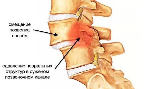 Головная боль отдающая в шею