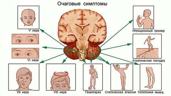 Опухоли мозжечка