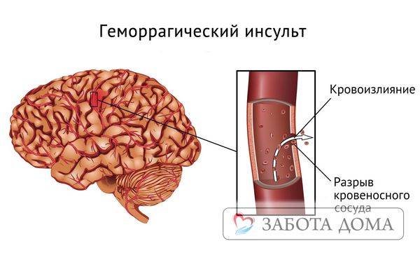 Геморрагический инсульт прогноз выздоровления