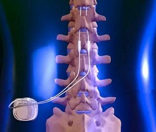 Стимулятор спинного мозга и нейропатические боли