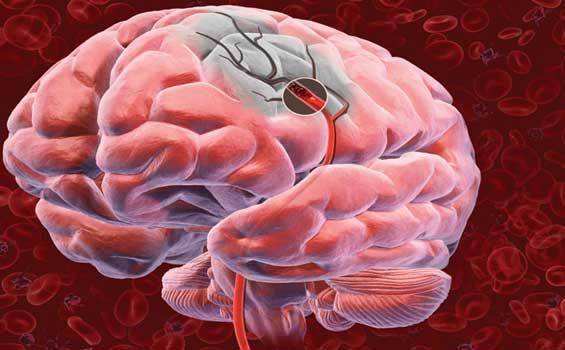 Разновидности и лечение нарушений кровообращения головного мозга