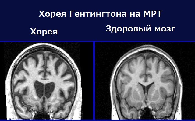 Хорея гентингтона: причины болезни, симптомы синдрома у детей