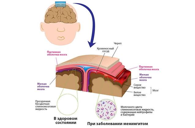 Менингит, первые симптомы минингитовой инфекции у детей, лечение