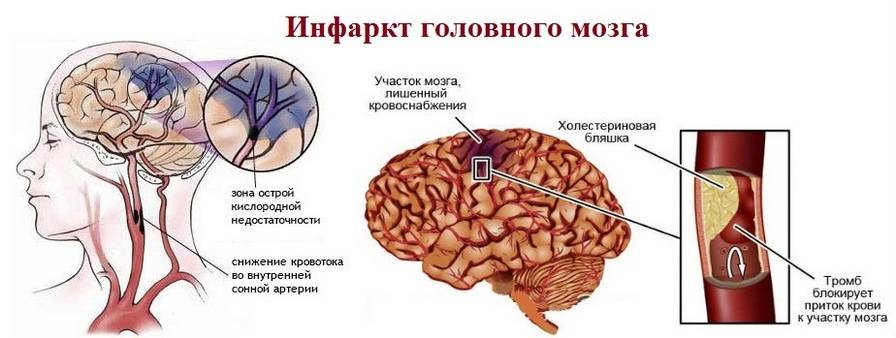 Ишемический инсульт карта