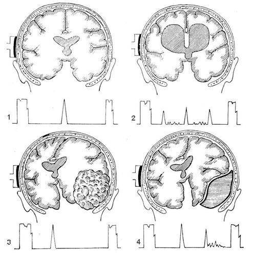 Эхоэнцефалография Эхо Эг головного мозга: что это такое Описание метода и расшифровка эхоэнцефалограммы