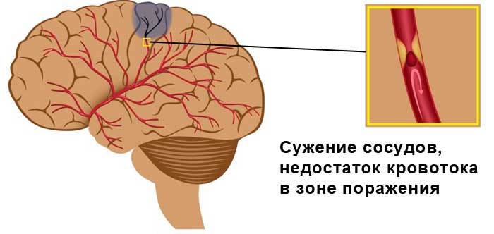 Лакунарный ишемический инсульт головного мозга прогноз