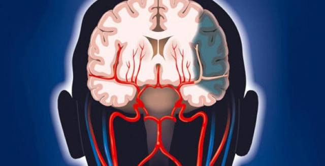 Нарушение кровообращения головного мозга: причины, симптомы, лечение, реабилитация