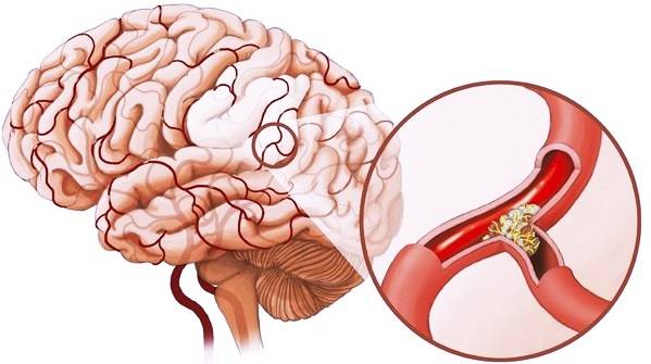 Как распознать инсульт головного мозга: симптомы и первая помощь