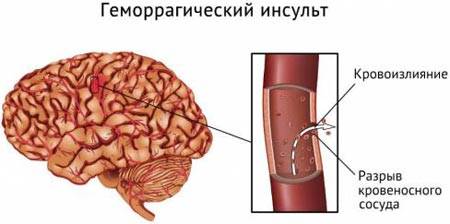 Геморрагический инсульт