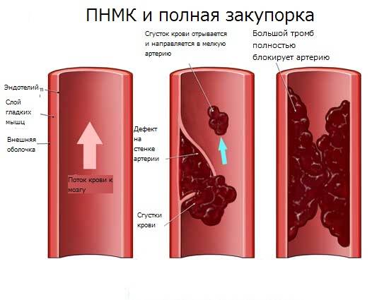 Ишемическая атака головного мозга что это