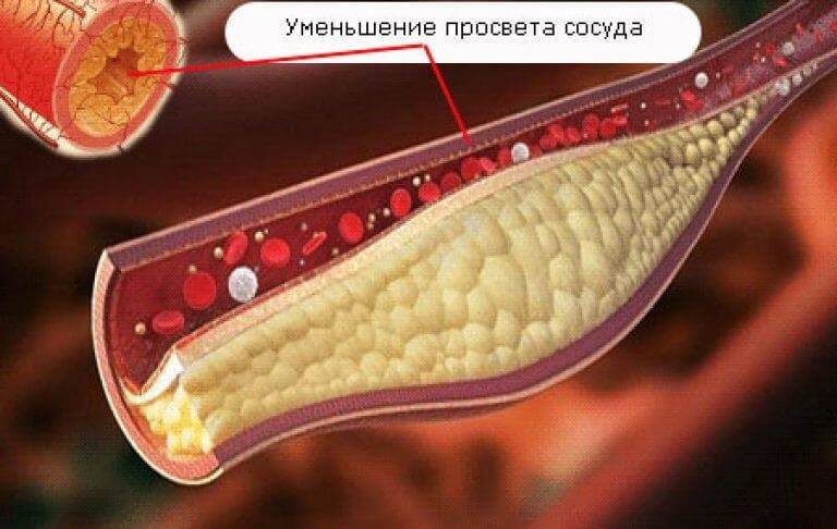 Бляшки в сосудах головного мозга