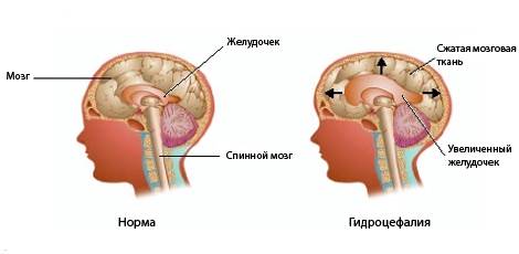 Перинатальная энцефалопатия у детей: симптомы, лечение, последствия во взрослой жизни