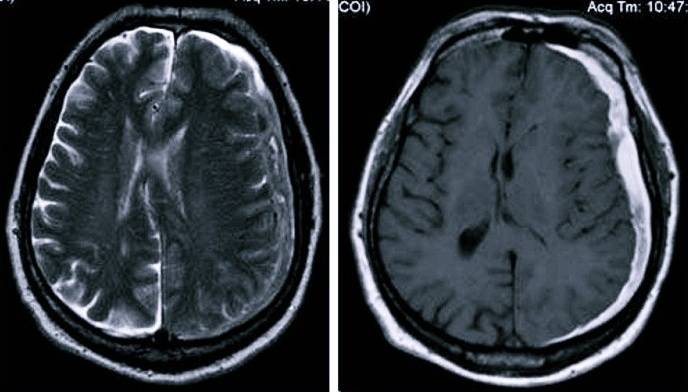 Субдуральная гематома головного мозга: лечение и последствия