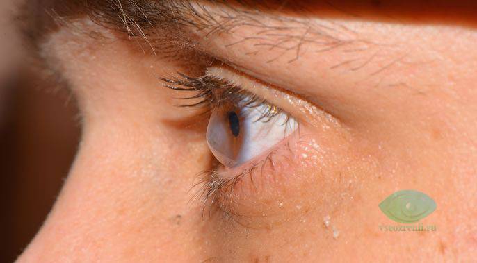 Диплопия - что это такое, это двоение в глазах: лечение и причины бинокулярной и монокулярной