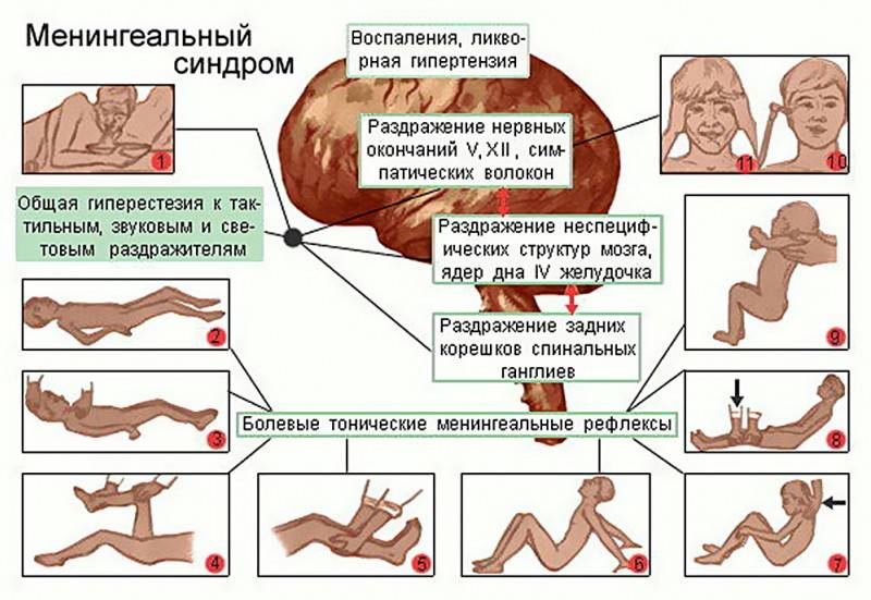 Менингит, первые симптомы минингитовой инфекции у детей, лечение