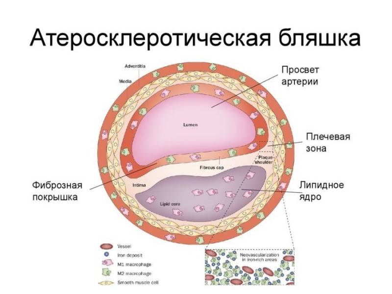 Бляшки в сосудах головного мозга