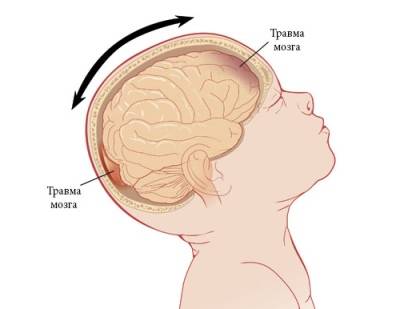 Гидроцефалия головного мозга у новорожденных