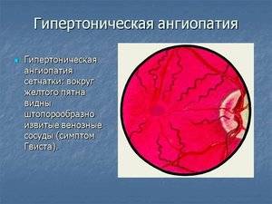 Ангиопатия сосудов сетчатки глаза: лечение, симптомы, причины