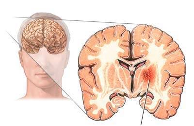 Виды операций по удалению опухолей головного мозга