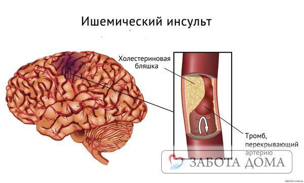Геморрагический инсульт прогноз выздоровления