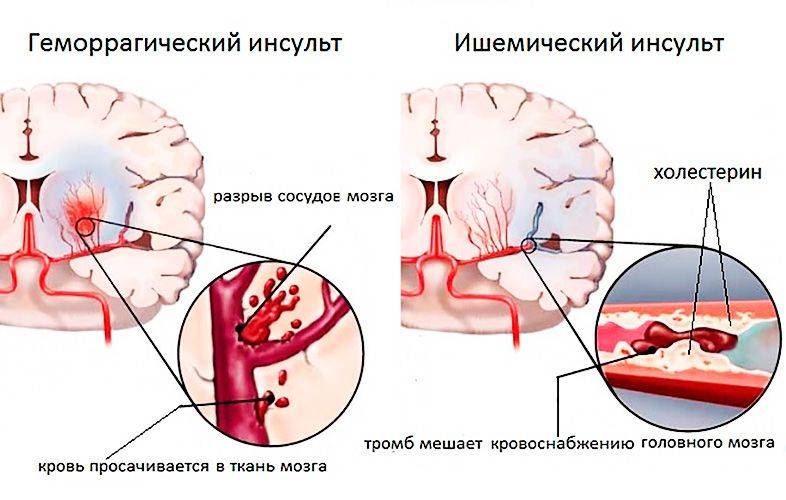 Ишемический инсульт картинки