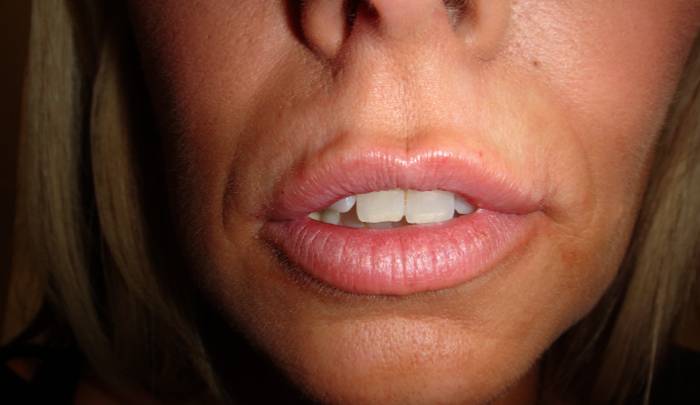 Немеет верхняя губа: причины, симптомы, избавление от патологии