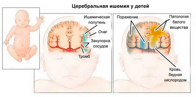 Причины и последствия церебральной ишемии у новорожденных