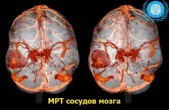 Ангиография сосудов головного мозга и шеи МР и КТ