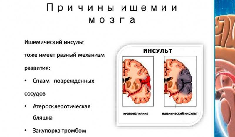 Ишемический инсульт прогноз для жизни