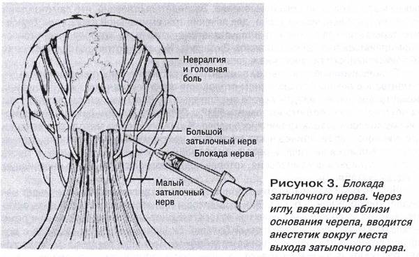 Головная боль отдающая в шею