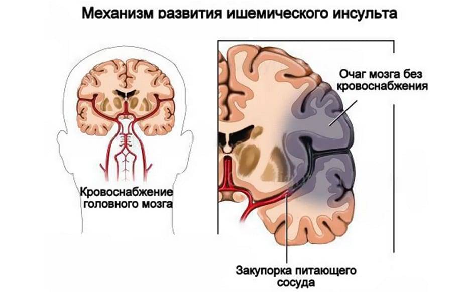 Ишемический инсульт карта