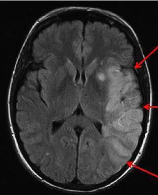 Как делают КТ-обследование головного мозга, что показывает томограмма головы, есть ли противопоказания