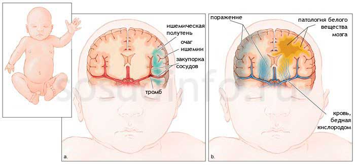 Энцефалопатия головного мозга: что это такое, лечение и последствия заболевания