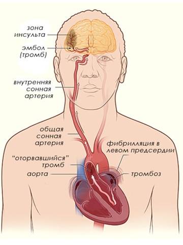 Аритмии сердца: основные виды, причины возникновения, механизмы развития, последствия для организма.
