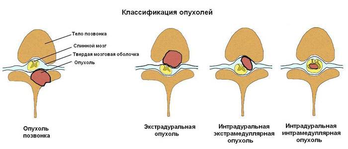 Опухоль спинного мозга, симптомы рака и диагностика онкологии, прогноз, сколько живут