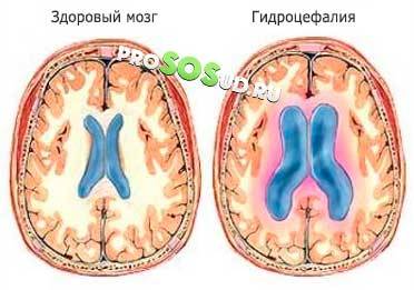 Расширение ликворных пространств головного мозга у взрослых