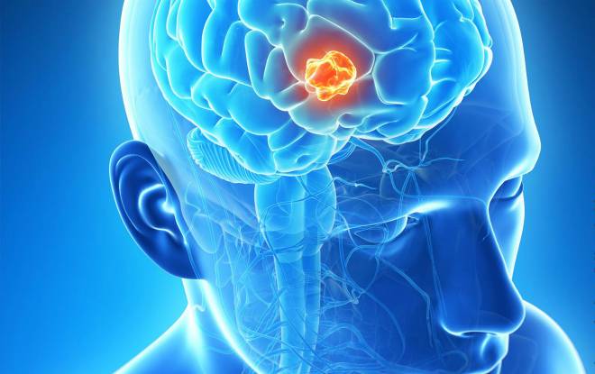 Аневризмы и мальформация сосудов головного мозга