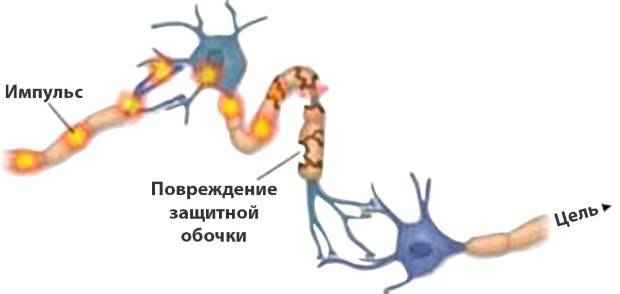 Полинейропатия конечностей