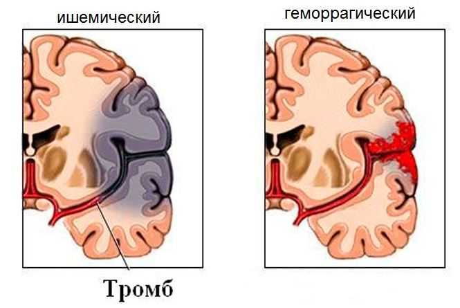 Предынсультное состояние: симптомы и признаки, предвестники инсульта, как определить, что делать