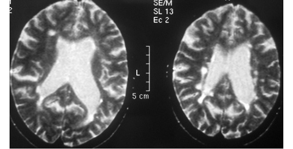Энцефалопатия головного мозга у детей и взрослых
