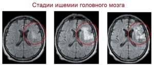 Ишемия сосудов головного мозга