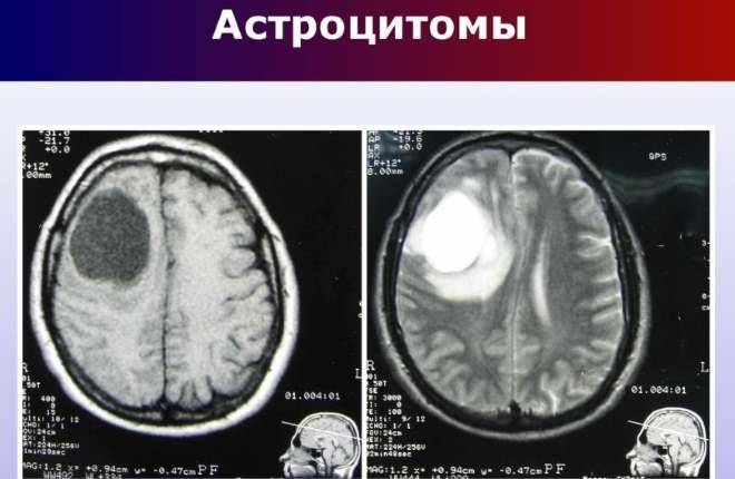 Астроцитома головного мозга: причины, симптомы, лечение, прогноз