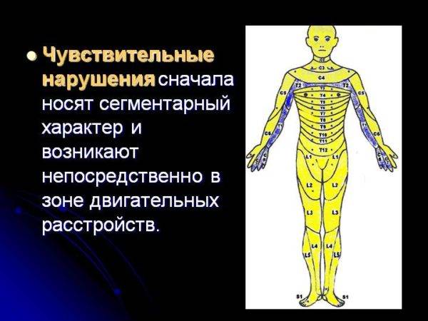 Опухоль спинного мозга, симптомы рака и диагностика онкологии, прогноз, сколько живут