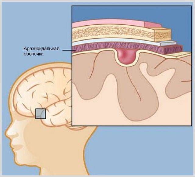 Арахноидальная киста головного мозга размеры норма