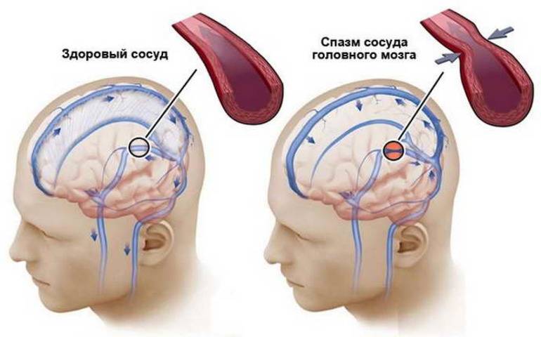 Сужение сосудов головного мозга лечение симптомы причины