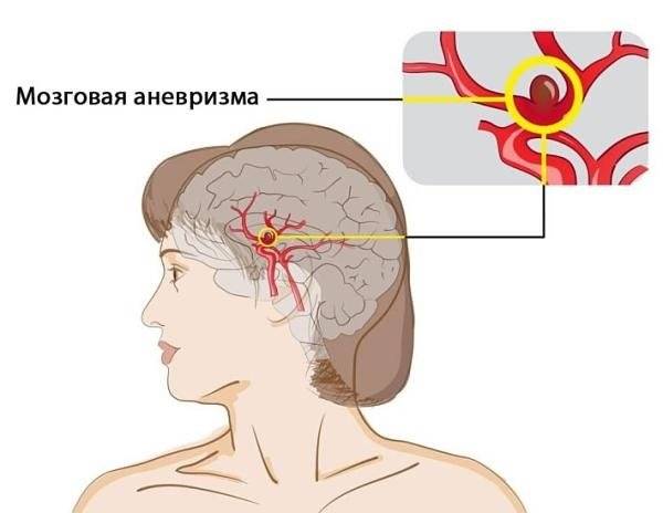 Сужение сосудов головного мозга лечение симптомы причины