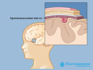 Арахноидальная киста головного мозга размеры норма