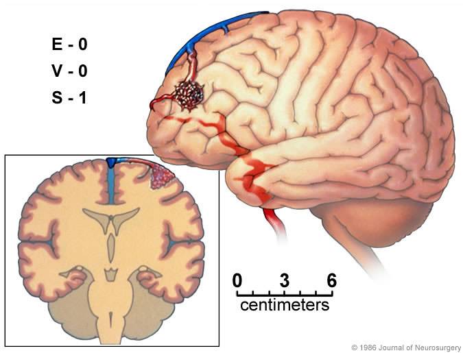 Аневризмы и мальформация сосудов головного мозга