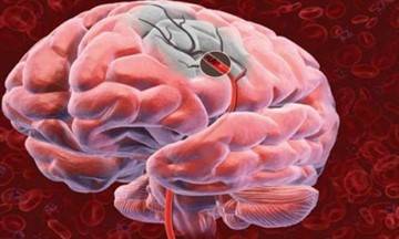 Алкогольная энцефалопатия головного мозга: признаки, последствия и прогноз