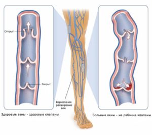 заболевания сосудов нижних конечностей: симптомы и лечение сосудистых болезней ног